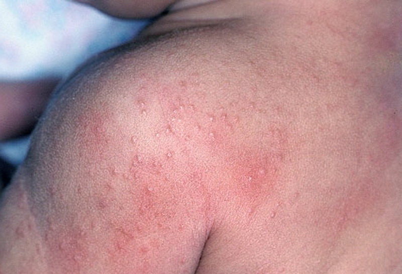 Аллергия на мед: причины, симптомы, лечение